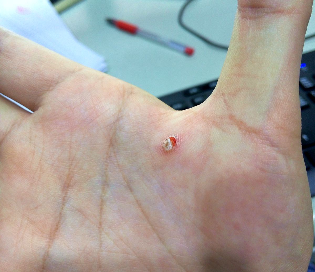 太凶残！我亲手从自己身上撕下了块肉