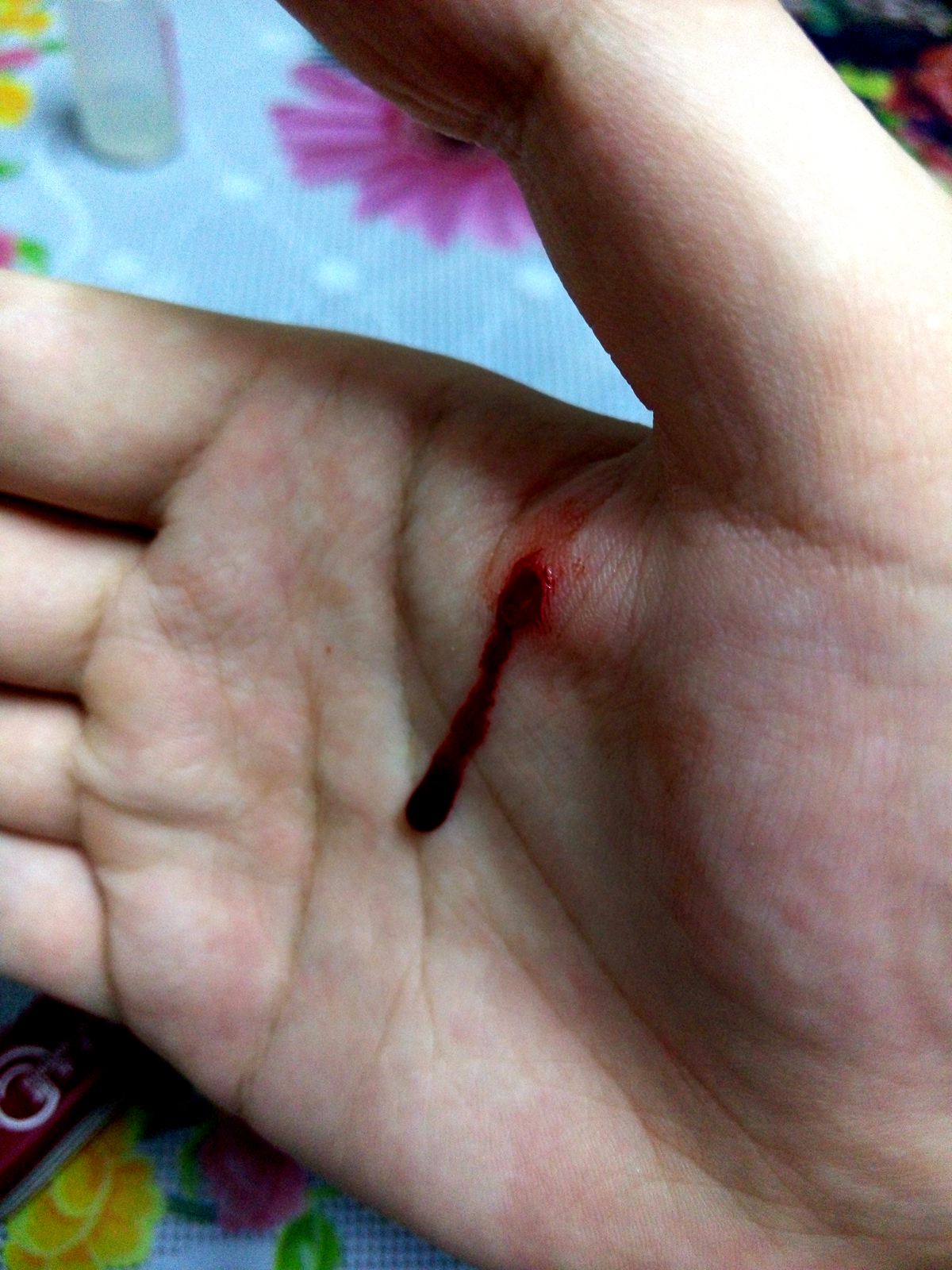 太凶残！我亲手从自己身上撕下了块肉